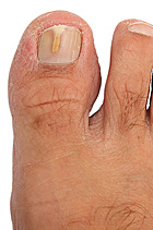Fungal infection big toe