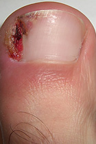 Ingrown toe nai