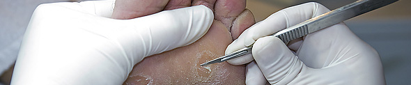 Removing hard skin