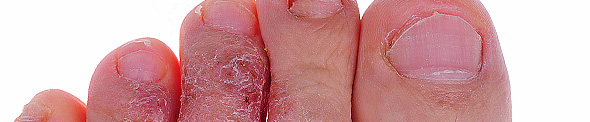 Fungal infection toes
