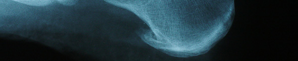 XRay Heel Spur