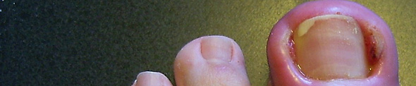 Ingrown toe nail